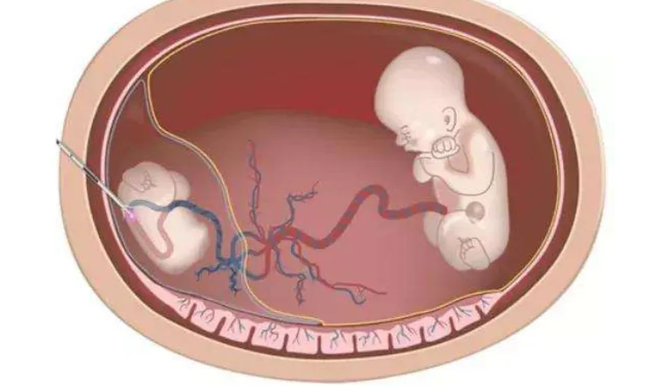 ԹȡѶٸ_Թȡ15mmĻȡ_ԹȡѶĿȡ