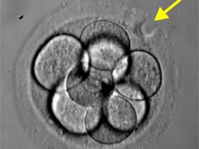 三代试管养囊_巧囊试管卵巢功能早衰_多囊卵巢综合症可以试管怀孕吗?